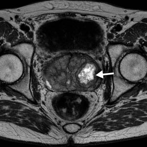 prostate lesion on mri image-1
