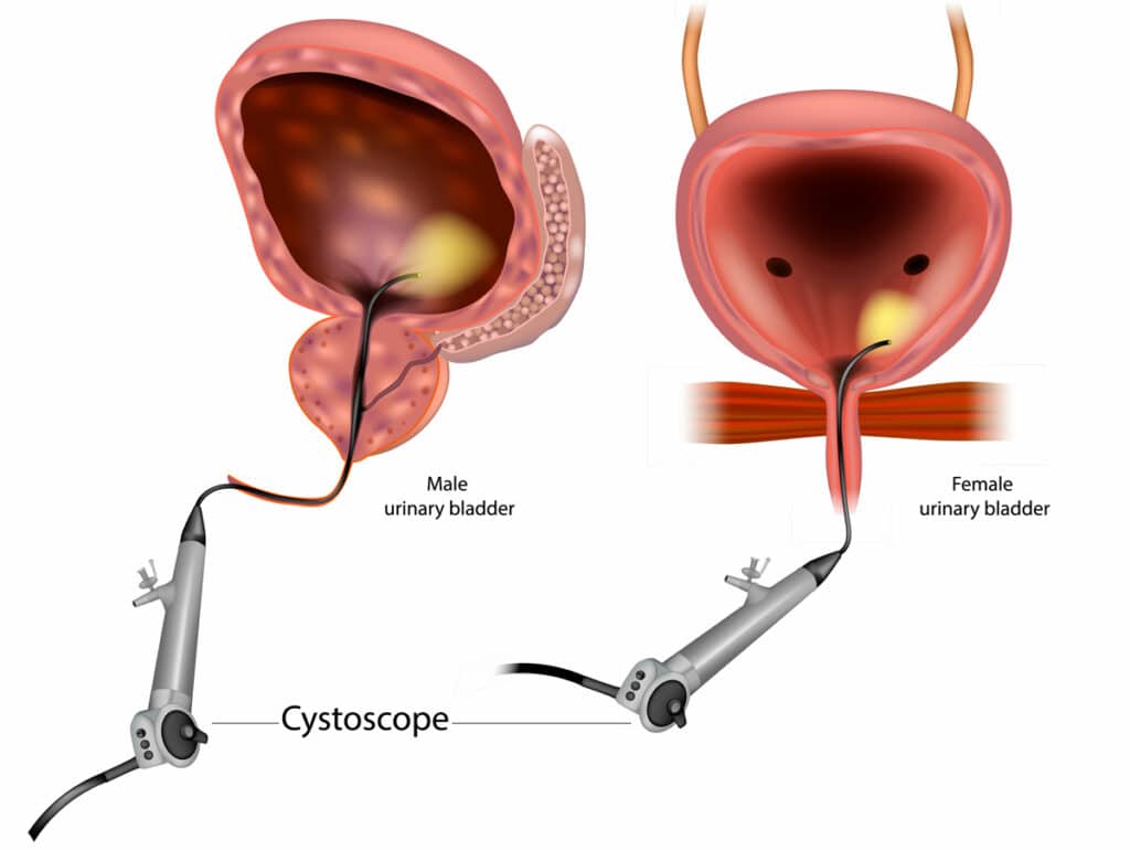 Diagnose and treat urinary tract issues with Integrative Urology's advanced cystoscopy procedures. Our experienced urologists provide personalized care for optimal treatment outcomes. Learn more on our website.
